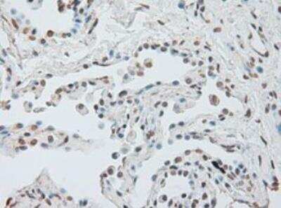 Immunohistochemistry-Paraffin: IL-6 Antibody (OTI3G9) - Azide and BSA Free [NBP2-71027] - Staining of Carcinoma of Human lung tissue using anti-IL-6 mouse monoclonal antibody. (Heat-induced epitope retrieval by 10mM citric buffer, pH6.0, 100 degrees C for 10min.