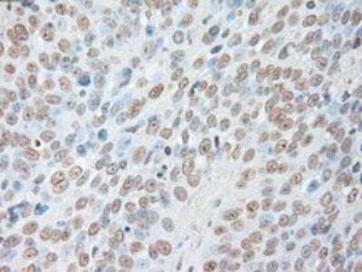 Immunohistochemistry-Paraffin: IL-6 Antibody (OTI3G9) - Azide and BSA Free [NBP2-71027] - Staining of Adenocarcinoma of Human ovary tissue using anti-IL-6 mouse monoclonal antibody. (Heat-induced epitope retrieval by 10mM citric buffer, pH6.0, 100 degrees C for 10min.