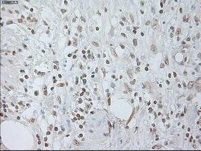 Immunohistochemistry-Paraffin: IL-6 Antibody (OTI3G9) - Azide and BSA Free [NBP2-71027] - Staining of paraffin-embedded Carcinoma of Human pancreas tissue using anti-IL6 mouse monoclonal antibody.
