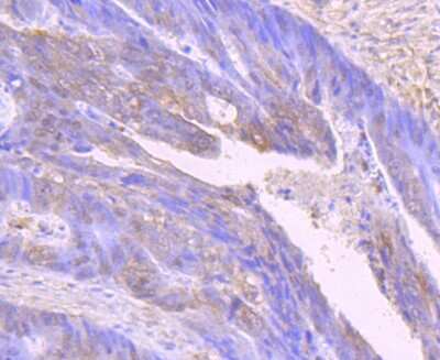 Immunohistochemistry-Paraffin: IL-7 Antibody (AH34-12) [NBP2-67277] - Analysis of paraffin-embedded human colon cancer tissue using anti-IL7 antibody. Counter stained with hematoxylin.