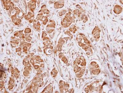 Immunohistochemistry-Paraffin: IL17RD Antibody [NBP2-16944] - Immunohistochemical analysis of paraffin-embedded Breast ca, using antibody at 1:250 dilution.