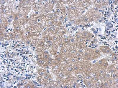 Immunohistochemistry-Paraffin: IL27 Antibody [NBP2-16951] - Immunohistochemical analysis of paraffin-embedded Hepatoma, using antibody at 1:500 dilution.