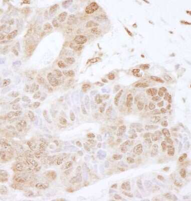 <b>Independent Antibodies Validation and Biological Strategies Validation.</b>Immunohistochemistry-Paraffin: ILF1 Antibody [NB100-88147] - Human ovarian carcinoma. Antibody used at a dilution of 1:200 (1ug/ml).