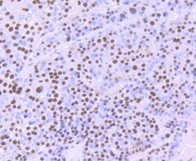 Immunohistochemistry-Paraffin: ILF2 Antibody (JU50-33) [NBP2-75539] - Analysis of paraffin-embedded human liver cancer tissue using anti-ILF2 antibody. Counter stained with hematoxylin.