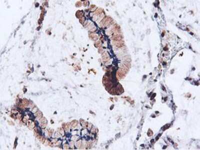 Immunohistochemistry-Paraffin: ILVBL Antibody (8B12) [NBP2-00883] - Staining of paraffin-embedded Adenocarcinoma of Human colon tissue using anti-ILVBL mouse monoclonal antibody.