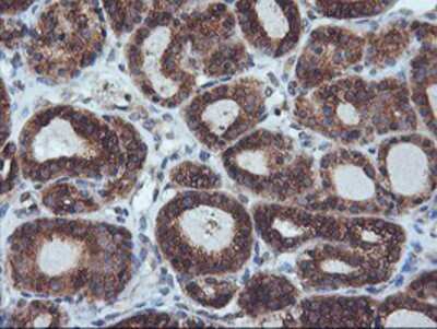 Immunohistochemistry-Paraffin: ILVBL Antibody (8B12) [NBP2-00883] - Staining of paraffin-embedded Carcinoma of Human thyroid tissue using anti-ILVBL mouse monoclonal antibody.