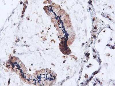 Immunohistochemistry: ILVBL Antibody (OTI8B12) - Azide and BSA Free [NBP2-71661] - Staining of paraffin-embedded Adenocarcinoma of Human colon tissue using anti-ILVBL mouse monoclonal antibody.