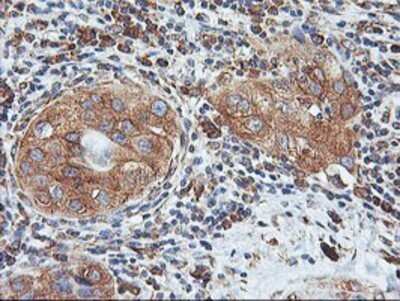 Immunohistochemistry: ILVBL Antibody (OTI8B12) - Azide and BSA Free [NBP2-71661] - Staining of paraffin-embedded Carcinoma of Human bladder tissue using anti-ILVBL mouse monoclonal antibody.