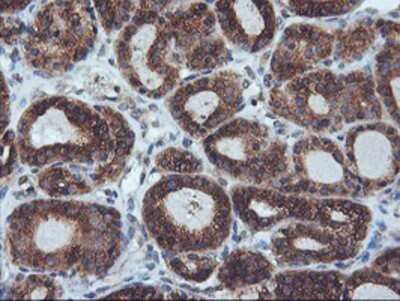Immunohistochemistry: ILVBL Antibody (OTI8B12) - Azide and BSA Free [NBP2-71661] - Staining of paraffin-embedded Carcinoma of Human thyroid tissue using anti-ILVBL mouse monoclonal antibody.