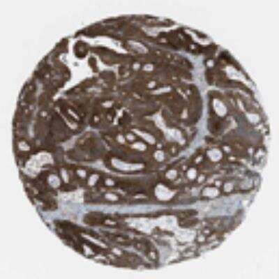 Immunohistochemistry: IMP2/IGF2BP2 Antibody [23750002] - Both normal and malignant tissues showed moderate to strong cytoplasmic staining. In normal tissues, surface epithelial cells of bronchus, glandular cells of the intestine, endometrium and cervix, and trophoblastic cells displayed strong cytoplasmic staining. Pancreas, surface epithelial cells of oral mucosa, vagina and cervix, non-neuronal cells of CNS tissues and lymphoid tissues were negative. Colo-rectal, skin and testis carcinomas exhibited strong cytoplasmic staining while ovarian, stomach and pancreas malignancies displayed moderate to strong cytoplasmic staining. Malignant carcinoids showed weak cytoplasmic and nuclear staining. Renal and prostate malignancies were weak to negative.  Image and statement courtesy of the Human Protein Atlas (HPA).