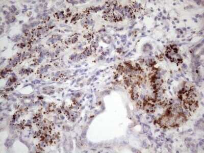 Immunohistochemistry: INAVA Antibody (OTI6A6) - Azide and BSA Free [NBP2-72021] - Analysis of Carcinoma of Human pancreas tissue. (Heat-induced epitope retrieval by 1 mM EDTA in 10mM Tris, pH8.5, 120C for 3min)
