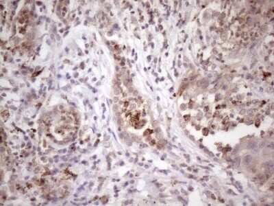 Immunohistochemistry: INAVA Antibody (OTI6A6) - Azide and BSA Free [NBP2-72021] - Analysis of Carcinoma of Human lung tissue. (Heat-induced epitope retrieval by 1 mM EDTA in 10mM Tris, pH8.5, 120C for 3min)