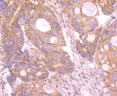 Immunohistochemistry-Paraffin: INSRR/IR-related receptor Antibody (JM22-38) [NBP2-66906] - Analysis of paraffin-embedded human colon cancer tissue using anti-Insulin Receptor R antibody. Counter stained with hematoxylin.