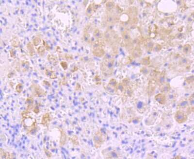Immunohistochemistry-Paraffin: INSRR/IR-related receptor Antibody (JM22-38) [NBP2-66906] - Analysis of paraffin-embedded human liver cancer tissue using anti-Insulin Receptor R antibody. Counter stained with hematoxylin.