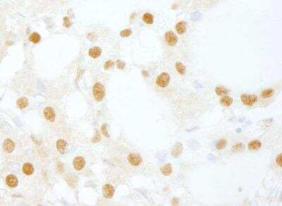 <b>Independent Antibodies Validation. </b>Immunohistochemistry-Paraffin: INTS6 Antibody [NB100-86990] - Human thyroid carcinoma. Antibody used at a dilution of 1:200 (1ug/ml).
