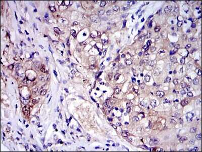 Immunohistochemistry-Paraffin: IRAK4 Antibody (2H9) [NBP2-37575] - Analysis of human lung cancer tissues using IRAK4 mouse mAb with DAB staining.