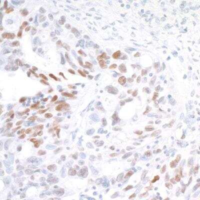 Immunohistochemistry: IRF1 Antibody (BLR039F) [NBP2-76419] - Detection of human IRF1 in FFPE ovarian carcinoma by IHC. Antibody: Rabbit anti-IRF1 recombinant monoclonal [BLR039F] (NBP2-76419). Secondary: HRP-conjugated goat anti-rabbit IgG. Substrate: DAB.