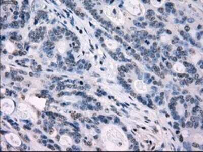 Immunohistochemistry: IRF3 Antibody (OTI2G3) - Azide and BSA Free [NBP2-71042] - Staining of paraffin-embedded Adenocarcinoma of colon tissue using anti-IRF3 mouse monoclonal antibody.