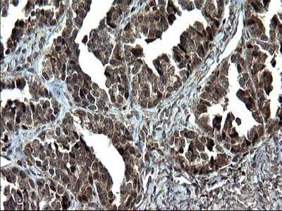 Immunohistochemistry: IRF5 Antibody (OTI1G7) - Azide and BSA Free [NBP2-71043] - Analysis of Adenocarcinoma of Human ovary tissue. (Heat-induced epitope retrieval by 1 mM EDTA in 10mM Tris, pH8.5, 120C for 3min)