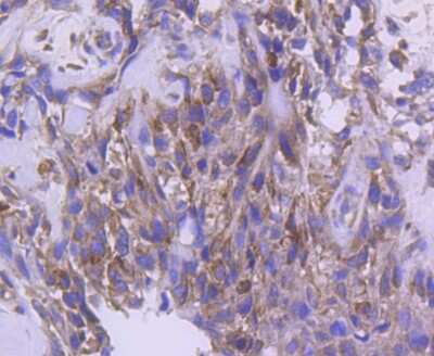 Immunohistochemistry-Paraffin: IRF5 Antibody (SN201-05) [NBP2-67730] - Analysis of paraffin-embedded human breast carcinoma tissue using anti-IRF5 antibody. Counter stained with hematoxylin.