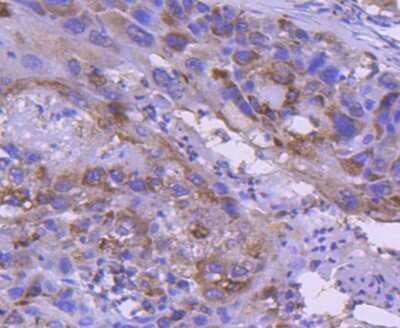 Immunohistochemistry-Paraffin: IRF5 Antibody (SN201-05) [NBP2-67730] - Analysis of paraffin-embedded human lung cancer tissue using anti-IRF5 antibody. Counter stained with hematoxylin.