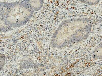 Immunohistochemistry: IRGM Antibody [NBP3-18254] - Immunohistochemistry analysis using Rabbit Anti-IRGM Polyclonal Antibody (NBP3-18254). Tissue: Colon Cancer. Species: Human. Fixation: Formalin Fixed Paraffin-Embedded. Primary Antibody: Rabbit Anti-IRGM Polyclonal Antibody (NBP3-18254) at 1:50 for 30 min at RT. Counterstain: Hematoxylin. Magnification: 20X. HRP-DAB Detection.