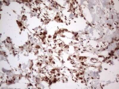 Immunohistochemistry: IRS1 Antibody (OTI3G10) - Azide and BSA Free [NBP2-71049] - Analysis of Adenocarcinoma of Human breast tissue. (Heat-induced epitope retrieval by 1mM EDTA in 10mM Tris buffer (pH8.5) at 120C for 3 min)