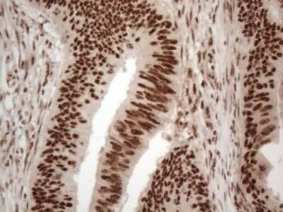 Immunohistochemistry: IRS1 Antibody (OTI3G10) - Azide and BSA Free [NBP2-71049] - Analysis of Adenocarcinoma of Human colon tissue. (Heat-induced epitope retrieval by 1mM EDTA in 10mM Tris buffer (pH8.5) at 120C for 3 min)