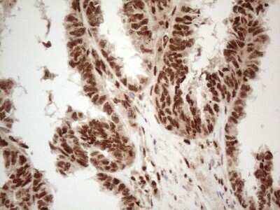 Immunohistochemistry: IRS1 Antibody (OTI3G10) - Azide and BSA Free [NBP2-71049] - Analysis of Adenocarcinoma of Human ovary tissue. (Heat-induced epitope retrieval by 1mM EDTA in 10mM Tris buffer (pH8.5) at 120C for 3 min)