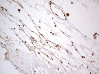 Immunohistochemistry: IRS1 Antibody (OTI3G10) - Azide and BSA Free [NBP2-71049] - Analysis of Carcinoma of Human kidney tissue. (Heat-induced epitope retrieval by 1mM EDTA in 10mM Tris buffer (pH8.5) at 120C for 3 min)