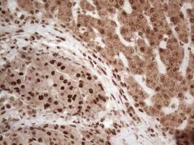 Immunohistochemistry: IRS1 Antibody (OTI3G10) - Azide and BSA Free [NBP2-71049] - Analysis of Carcinoma of Human liver tissue.(Heat-induced epitope retrieval by 1mM EDTA in 10mM Tris buffer (pH8.5) at 120C for 3 min)