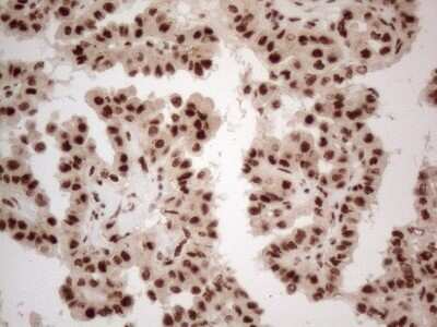 Immunohistochemistry: IRS1 Antibody (OTI3G10) - Azide and BSA Free [NBP2-71049] - Analysis of Carcinoma of Human thyroid tissue. (Heat-induced epitope retrieval by 1mM EDTA in 10mM Tris buffer (pH8.5) at 120C for 3 min)