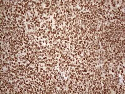 Immunohistochemistry: IRS1 Antibody (OTI3G10) - Azide and BSA Free [NBP2-71049] - Analysis of Human lymphoma tissue. (Heat-induced epitope retrieval by 1mM EDTA in 10mM Tris buffer (pH8.5) at 120C for 3 min)