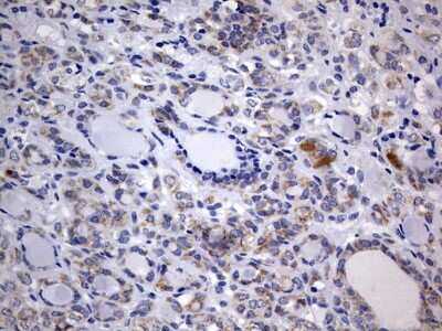 Immunohistochemistry: ISCU Antibody (4F5) [NBP2-45436] - Analysis of Carcinoma of Human thyroid tissue. (Heat-induced epitope retrieval by 10mM citric buffer, pH6.0, 120C for 3min)