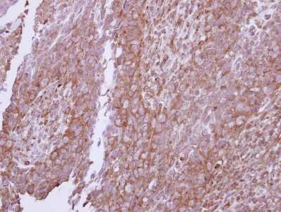 Immunohistochemistry-Paraffin: ITFG1 Antibody [NBP2-16998] - Immunohistochemical analysis of paraffin-embedded Breast ca, using antibody at 1:250 dilution.
