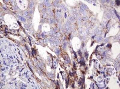 Immunohistochemistry: ITFG3 Antibody (OTI3B3) - Azide and BSA Free [NBP2-72253] - Analysis of Adenocarcinoma of Human breast tissue. (Heat-induced epitope retrieval by 10mM citric buffer, pH6.0, 120C for 3min)