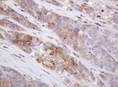 Immunohistochemistry: ITFG3 Antibody (OTI3B3) - Azide and BSA Free [NBP2-72253] - Analysis of Adenocarcinoma of Human colon tissue. (Heat-induced epitope retrieval by 10mM citric buffer, pH6.0, 120C for 3min)