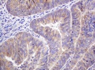 Immunohistochemistry: ITFG3 Antibody (OTI3B3) - Azide and BSA Free [NBP2-72253] - Analysis of Adenocarcinoma of Human endometrium tissue. (Heat-induced epitope retrieval by 10mM citric buffer, pH6.0, 120C for 3min)