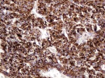 Immunohistochemistry: ITFG3 Antibody (OTI3B3) - Azide and BSA Free [NBP2-72253] - Analysis of Carcinoma of Human liver tissue.(Heat-induced epitope retrieval by 10mM citric buffer, pH6.0, 120C for 3min)