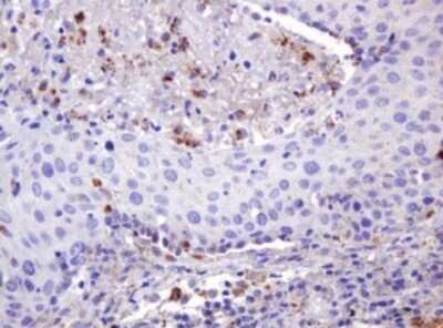 Immunohistochemistry: ITFG3 Antibody (OTI3B3) - Azide and BSA Free [NBP2-72253] - Analysis of Carcinoma of Human lung tissue.(Heat-induced epitope retrieval by 10mM citric buffer, pH6.0, 120C for 3min)