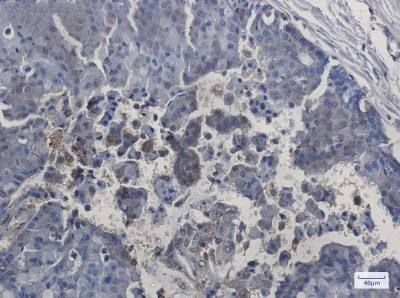 Immunohistochemistry-Paraffin: ITPA Antibody (S01-4D4) [NBP3-19664] - Immunohistochemistry of ITPA in paraffin-embedded Human breast cancer tissue using NBP3-19664 at dilution 1/50