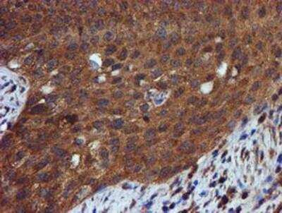 Immunohistochemistry-Paraffin: Iduronate 2-Sulfatase/IDS Antibody (1D9) [NBP2-01745] - Iduronate 2 sulfatase Antibody (1D9) [NBP2-01745] - Staining of paraffin-embedded Carcinoma of Human bladder tissue using anti-Iduronate 2 sulfatase mouse monoclonal antibody.