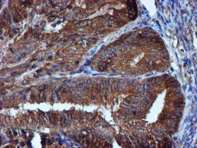 Immunohistochemistry-Paraffin: Iduronate 2-Sulfatase/IDS Antibody (4G2) [NBP2-01761] - Staining of paraffin-embedded Adenocarcinoma of Human endometrium tissue using anti-Iduronate 2 sulfatase mouse monoclonal antibody.