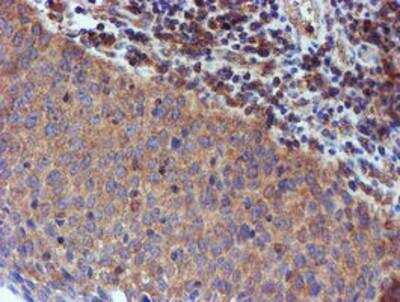 Immunohistochemistry-Paraffin: Iduronate 2-Sulfatase/IDS Antibody (4G2) [NBP2-01761] - Staining of paraffin-embedded Carcinoma of Human bladder tissue using anti-Iduronate 2 sulfatase mouse monoclonal antibody.