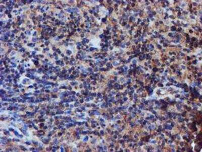 Immunohistochemistry-Paraffin: Iduronate 2-Sulfatase/IDS Antibody (4G2) [NBP2-01761] - Staining of paraffin-embedded Human lymphoma tissue using anti-Iduronate 2 sulfatase mouse monoclonal antibody.