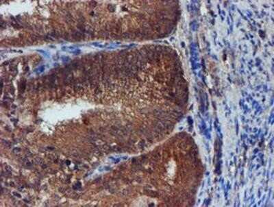 Immunohistochemistry: Iduronate 2-Sulfatase/IDS Antibody (OTI1D9) - Azide and BSA Free [NBP2-70994] - Staining of paraffin-embedded Adenocarcinoma of Human endometrium tissue using anti-Iduronate 2 sulfatase mouse monoclonal antibody.