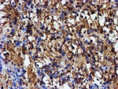 Immunohistochemistry: Iduronate 2-Sulfatase/IDS Antibody (OTI1D9) - Azide and BSA Free [NBP2-70994] - Staining of paraffin-embedded Carcinoma of Human kidney tissue using anti-Iduronate 2 sulfatase mouse monoclonal antibody.