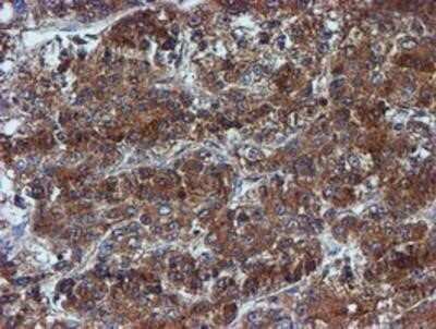 Immunohistochemistry: Iduronate 2-Sulfatase/IDS Antibody (OTI1D9) - Azide and BSA Free [NBP2-70994] - Staining of paraffin-embedded Carcinoma of Human liver tissue using anti-Iduronate 2 sulfatase mouse monoclonal antibody.