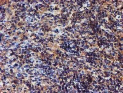 Immunohistochemistry: Iduronate 2-Sulfatase/IDS Antibody (OTI1D9) - Azide and BSA Free [NBP2-70994] - Staining of paraffin-embedded Human lymphoma tissue using anti-Iduronate 2 sulfatase mouse monoclonal antibody.
