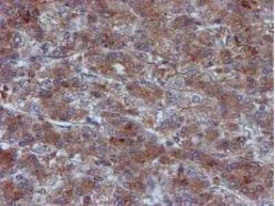 Immunohistochemistry: Iduronate 2-Sulfatase/IDS Antibody (OTI4G2) - Azide and BSA Free [NBP2-70996] - Carcinoma of Human liver tissue.
